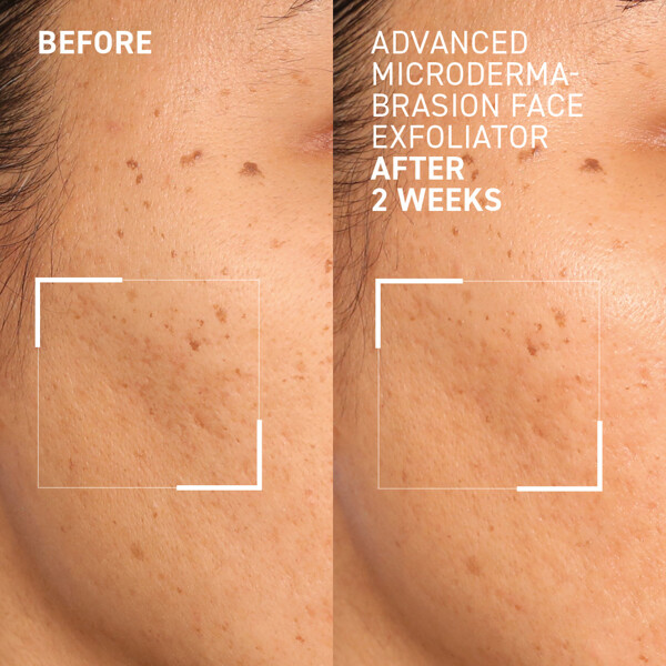 Advanced Microdermabrasion Face Exfoliator (Picture 3 of 4)