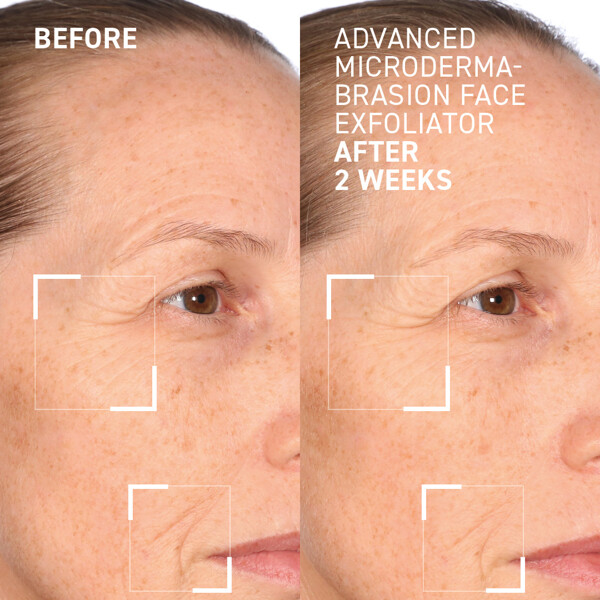 Advanced Microdermabrasion Face Exfoliator (Picture 4 of 4)